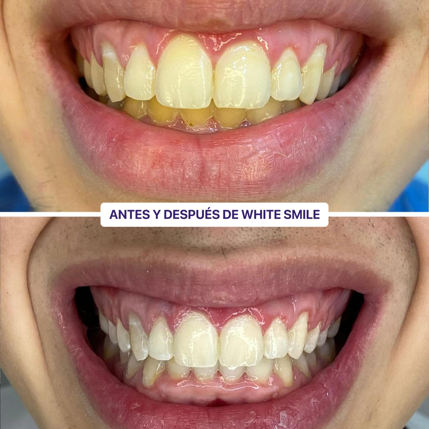 WhiteSmile Kit