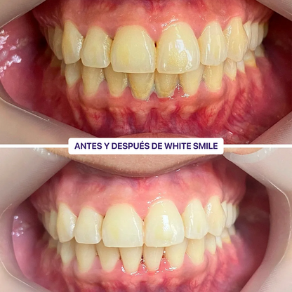 WhiteSmile Kit
