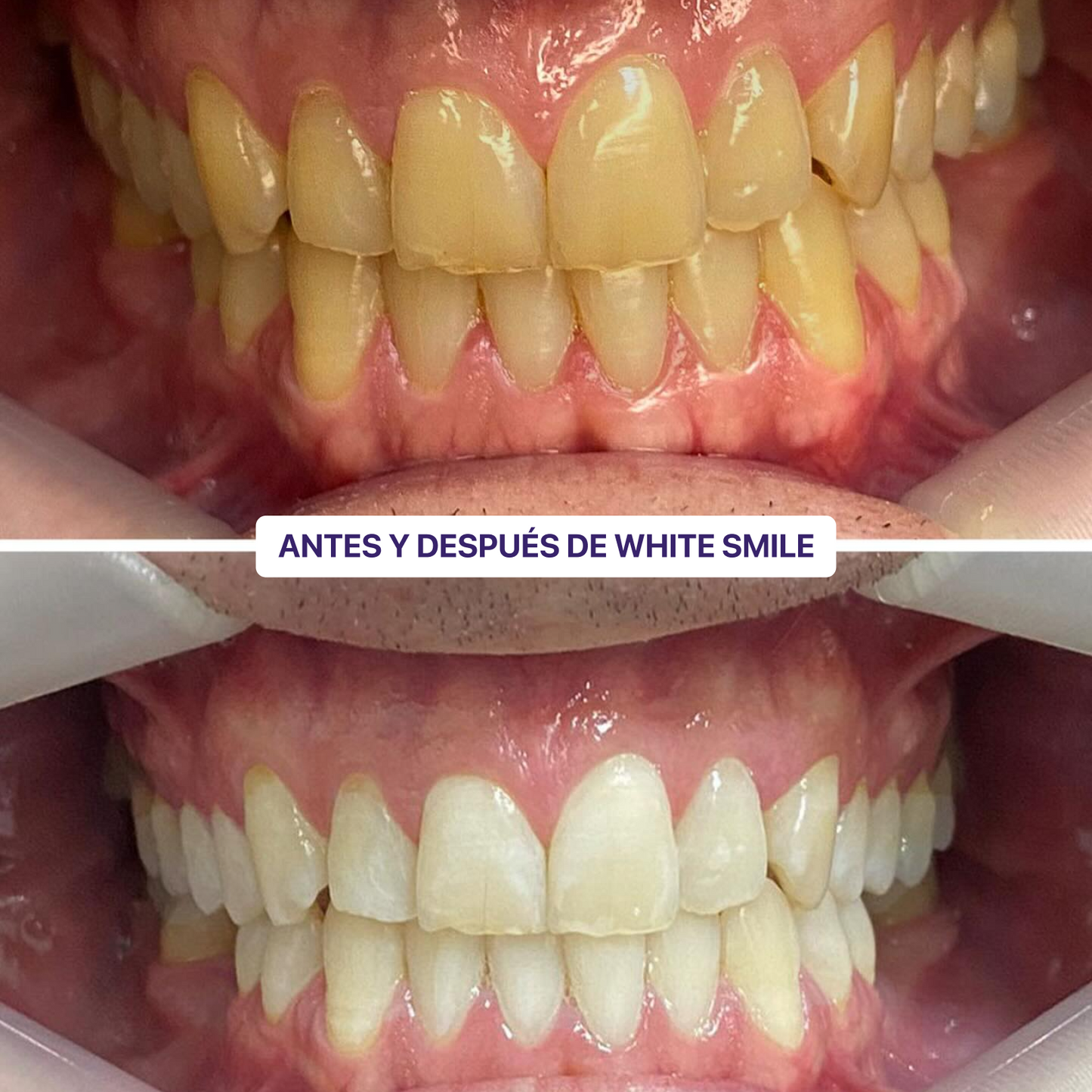 WhiteSmile Kit